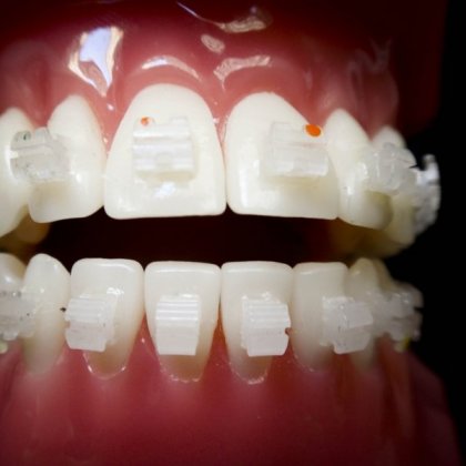 Bracket Cerámica de Alúmina Perfiles